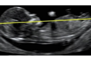 First Step - Fetal